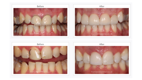 Before and after veneers on teeth