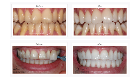 before and after tooth whitening results at our Leicester clinic